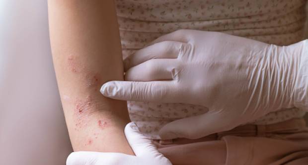 Neki simptomi koronavirusa mogu se pojaviti na koži: Ovo je pet vrsta osipa nakon zaraze covidom